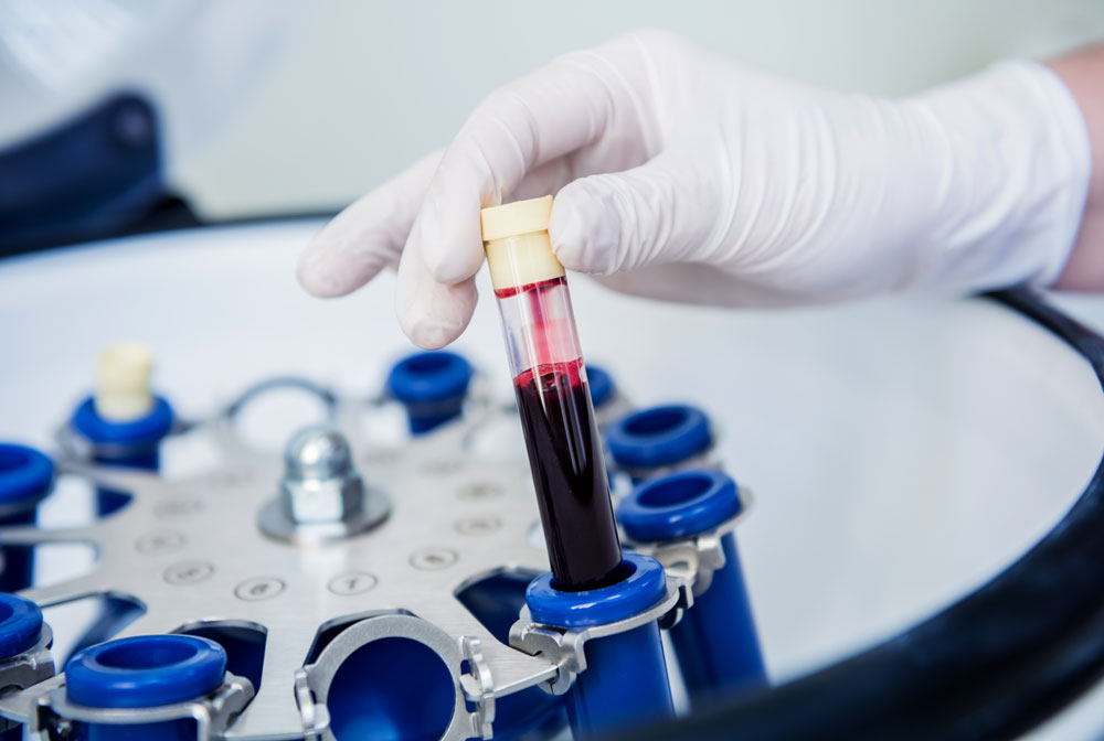 clinica-oria-blog-plasma-rico-en-plaquetas