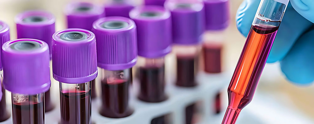 clinica-oria-gijon-blog-plasma-rico-en-plaquetas